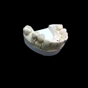 zirconia crown