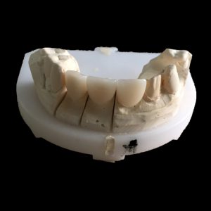 Zirconia crown